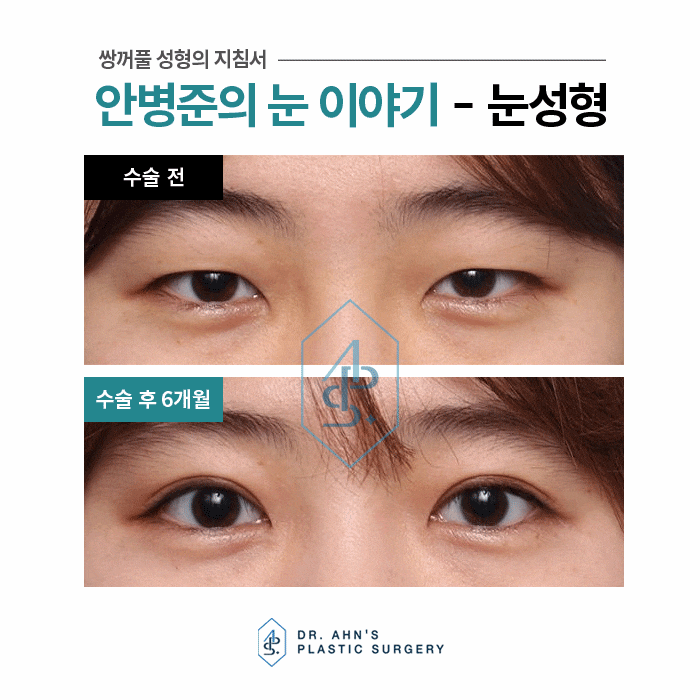 원하는 쌍꺼풀? 수술방법도 선택도 모두 다릅니다. 관련 이미지 1