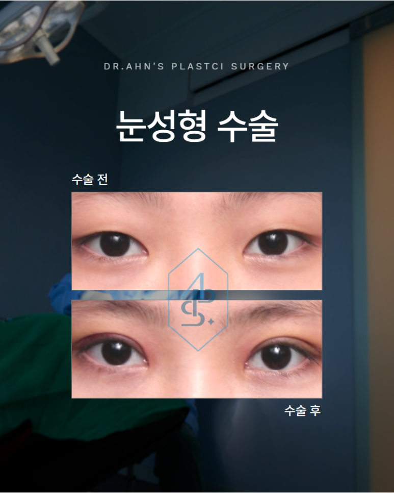 눈성형 수술 전문의와 함께 소통하면서 만들어지는 결과입니다 관련 이미지 1