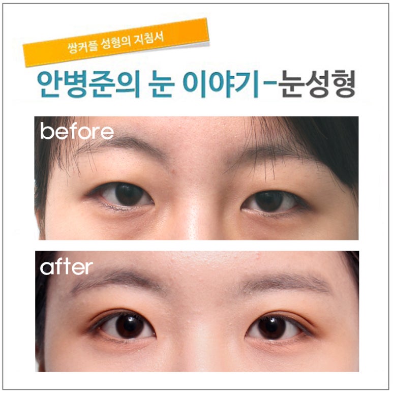 첫쌍수 1년 후.(쌍꺼풀수술,기본쌍꺼풀수술,자연스러운쌍꺼풀수술) 관련 이미지 1