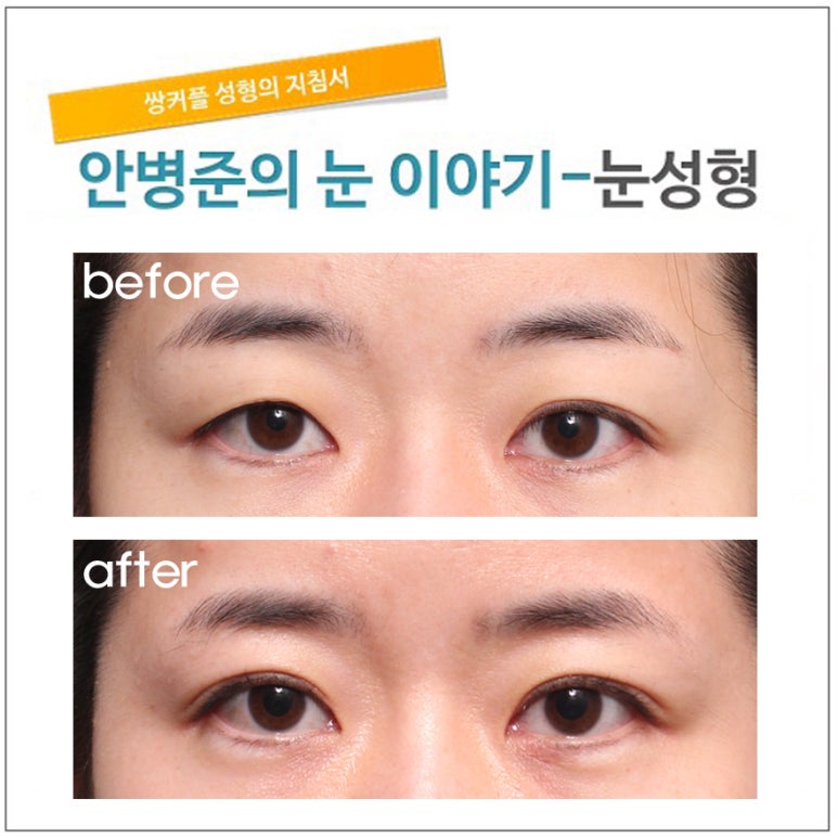 매몰법 풀린후 첫수술처럼(재수술,피부절제,지방재배치) 관련 이미지 1