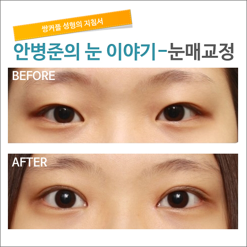 안검하수 눈매교정 눈성형잘하는병원 시크릿성형외과_안병준 관련 이미지 2