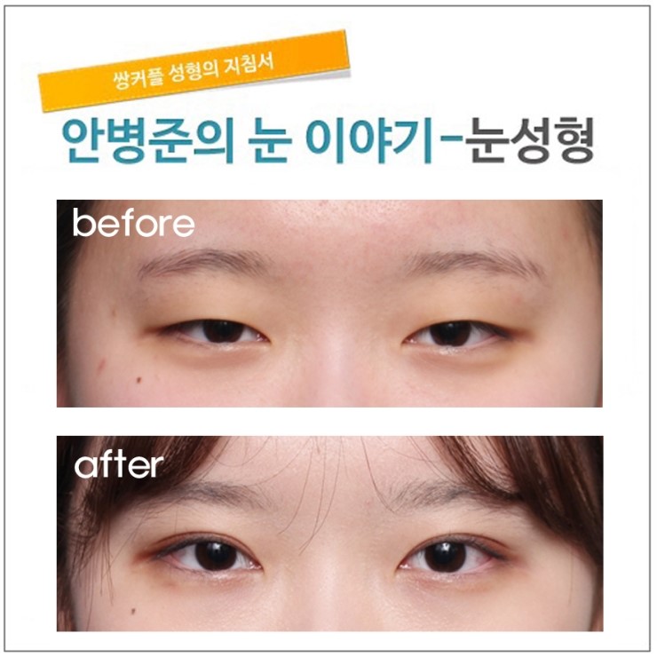 쌍꺼풀과 안검하수3개월후 관련 이미지 1