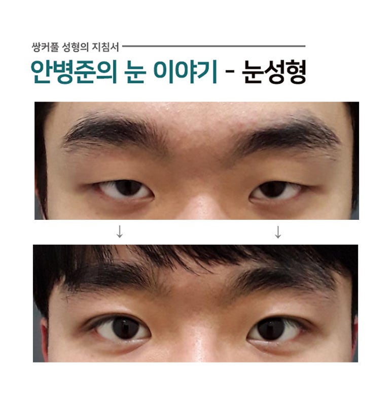 남자 쌍꺼풀 사례(안검하수,꺼진눈)#3~4 관련 이미지 1