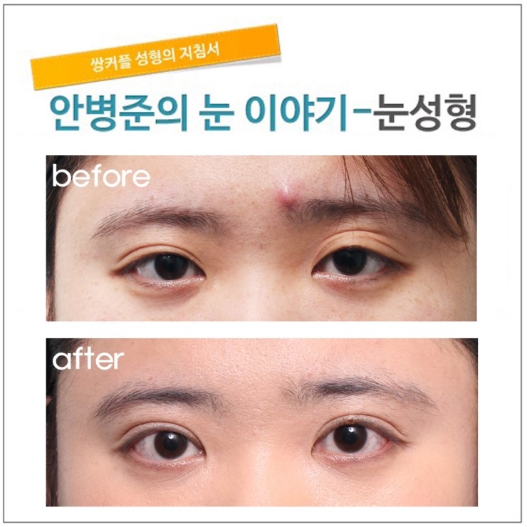 두번의 수술을 한 후, 약간의 졸림과 겹주름. 관련 이미지 1