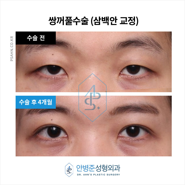 [쌍꺼풀수술] 이백안과 삼백안! 그것이 알고 싶다~! 관련 이미지 4