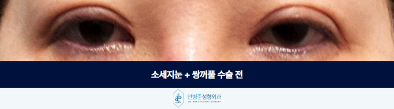 소세지눈 쌍꺼풀 크고 자연스러운 라인은 없습니다 관련 이미지 2