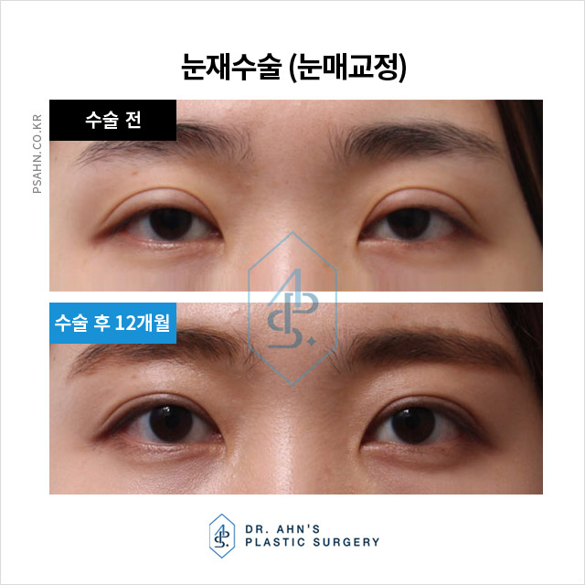 눈성형재수술,왜 필요한 걸까요? 흔한 실패 원인 분석 관련 이미지 4