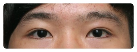 남자눈매교정 안검하수 관련 이미지 3