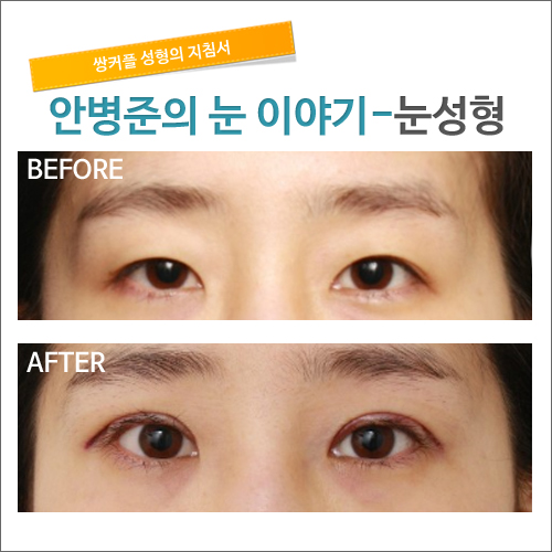 눈성형 4개월후 경과사진 관련 이미지 1
