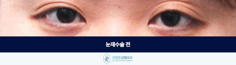 눈재수술성형외과 여러 번 수술 후에도 남아있는 고민이라면 관련 이미지 2