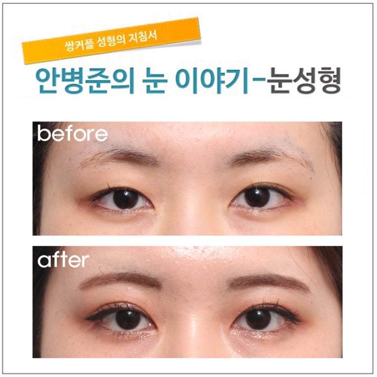 부분 절개법 관련 이미지 1