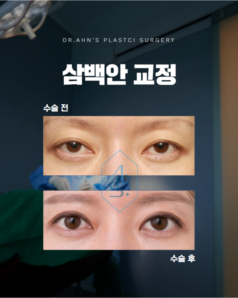 삼백안 교정 원인을 먼저 세심하게 봐야 합니다 관련 이미지 1