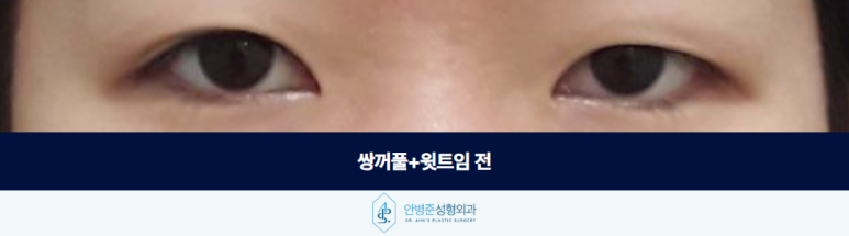 쌍꺼풀 윗트임 가짜 안검하수 판단하기 전에 알아야 할 것 관련 이미지 2