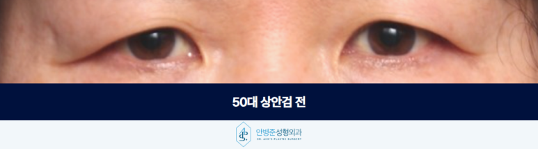 50대 상안검 나이들수록 처진 눈꺼풀이 콤플렉스로 다가온다면 관련 이미지 2