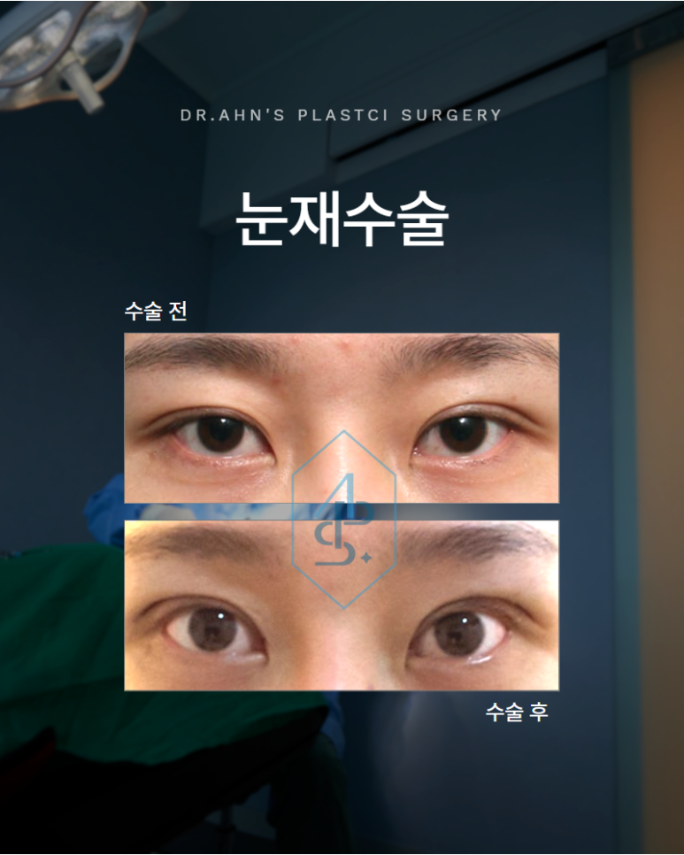 눈재수술 이전 수술의 흔적을 자연스럽게 디자인하는 과정 관련 이미지 1