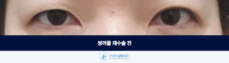 쌍꺼풀 재수술 가짜 안검하수 눈매교정이 필요 없는 눈은 어떻게 구분할까 관련 이미지 2