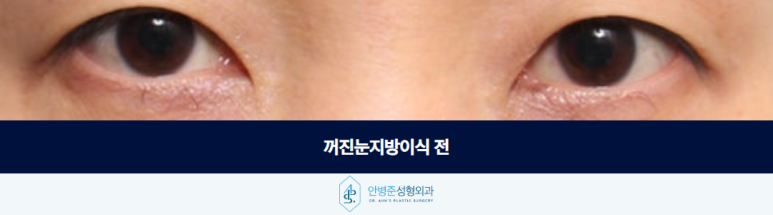 꺼진눈지방이식 볼륨을 채우기 전에 먼저 고려해야 할 점은 관련 이미지 2