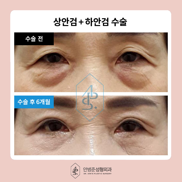 [눈성형]50대도 동안 유지! 상안검&하안검 성형으로 자신감 찾기 관련 이미지 8