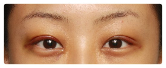 [안병준의 눈이야기]-안병준 성형외과 관련 이미지 2