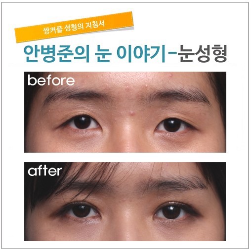 풀린 쌍꺼풀수술,다시 바로잡기. 관련 이미지 1