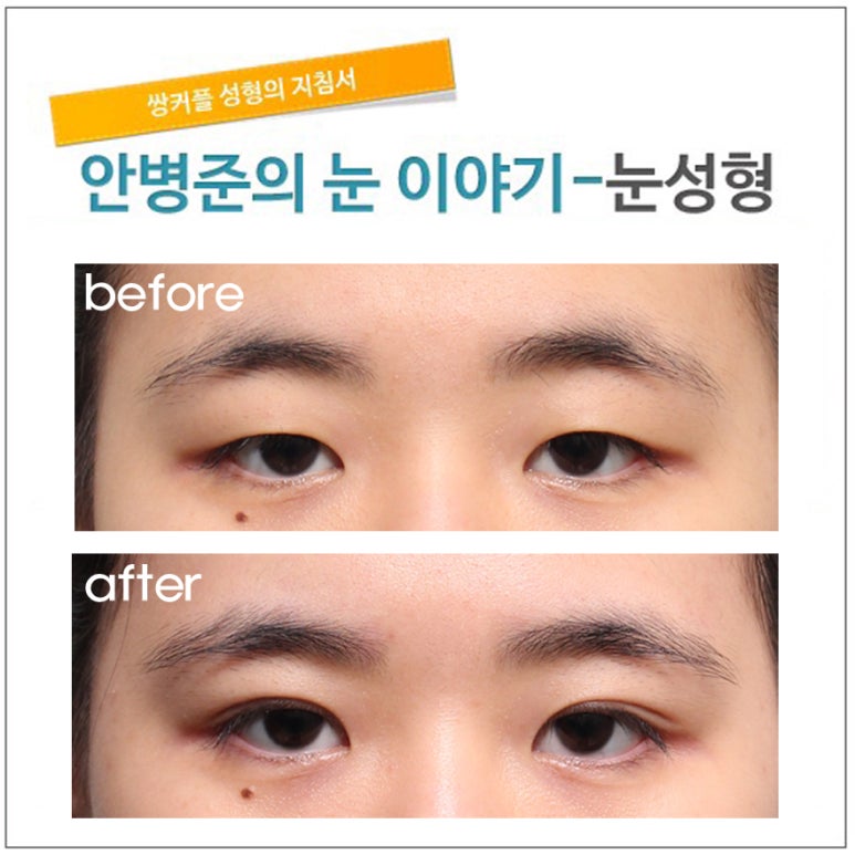 가장 동양적인 눈(쌍꺼풀,윗트임) 관련 이미지 1