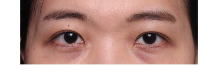 삼백안 교정 관련 이미지 3