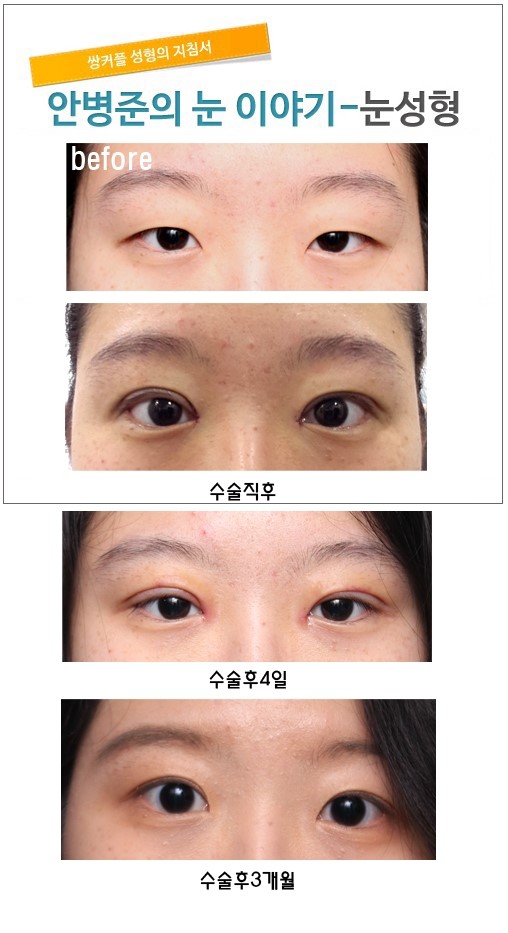 쌍꺼풀 수술과 앞트임 관련 이미지 1