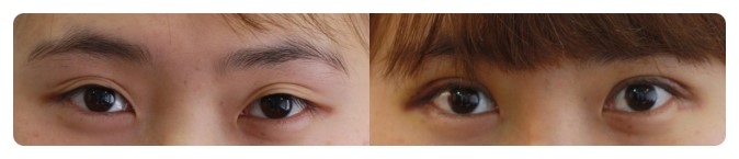 안병준의 쌍꺼풀 지침서4_쌍꺼풀수술 왜 하는가? 관련 이미지 5