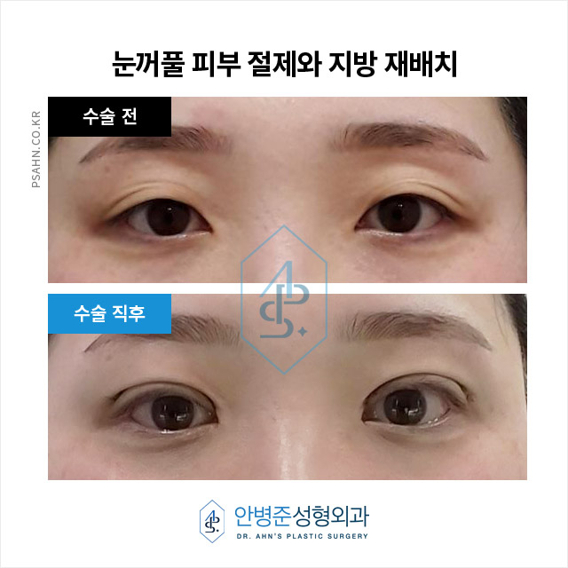 눈꺼풀 처짐,중앙부위에 지방이 없고 겹주름 수술사례 관련 이미지 2