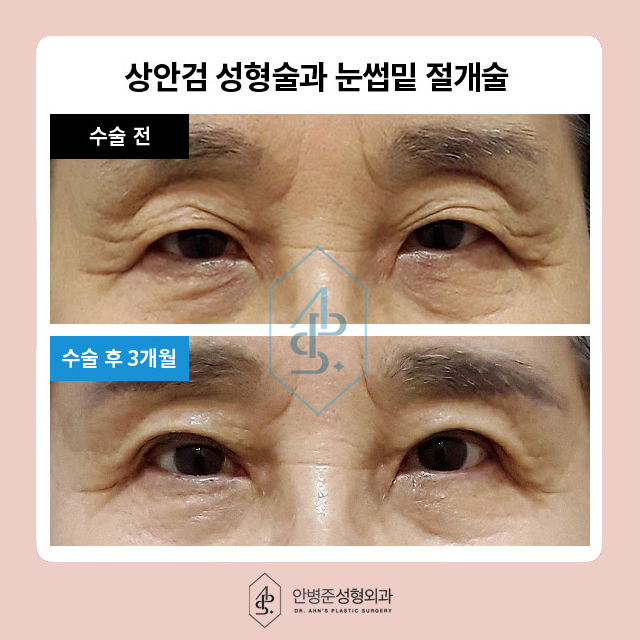 [눈성형]50대도 동안 유지! 상안검&하안검 성형으로 자신감 찾기 관련 이미지 4
