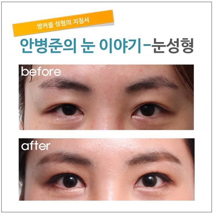 얼굴 비대칭으로 인한 짝짝이 눈. (짝짝이눈교정,짝눈교정,짝눈수술) 관련 이미지 1