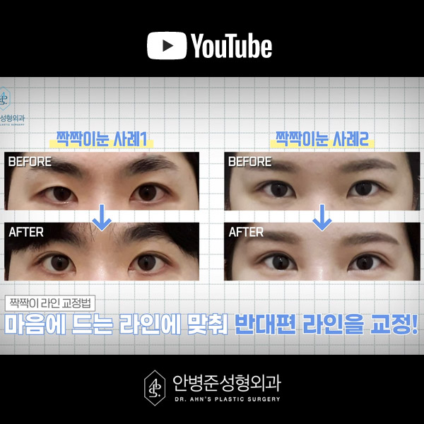 [방배역성형외과] 쌍꺼풀 수술 후 부작용과 대처 방법 관련 이미지 4