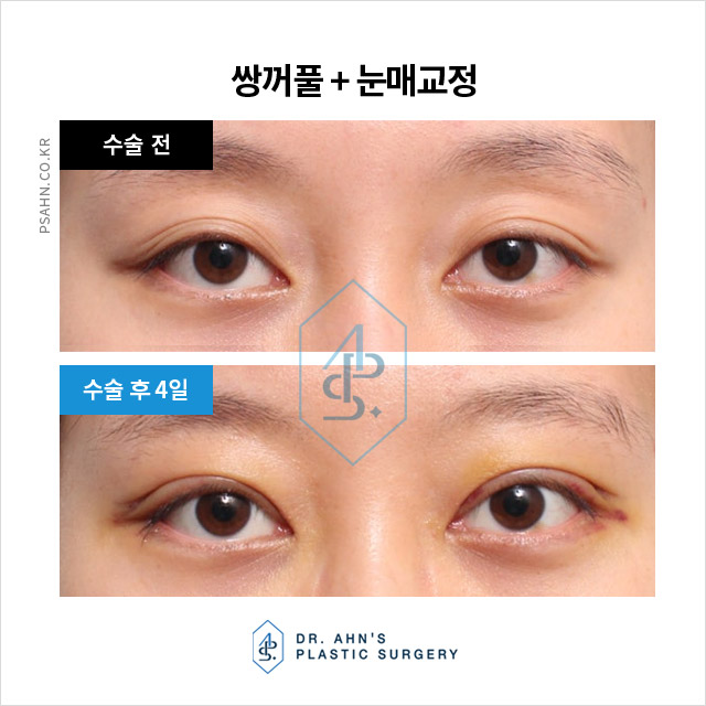 함몰눈,돌출눈 쌍꺼풀 - 눈 형태에 따른 눈성형 방법 관련 이미지 1