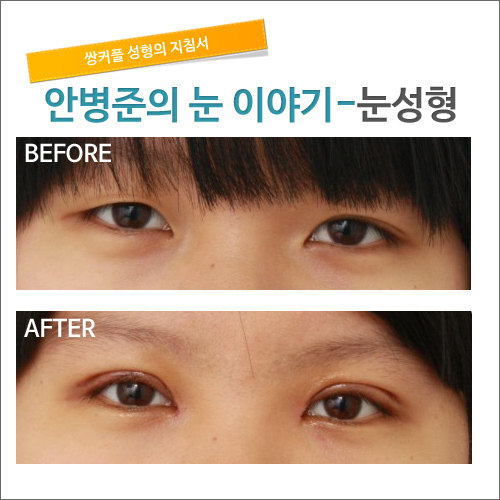 짝짝이눈 쌍꺼풀수술 한달반 경과후 관련 이미지 1