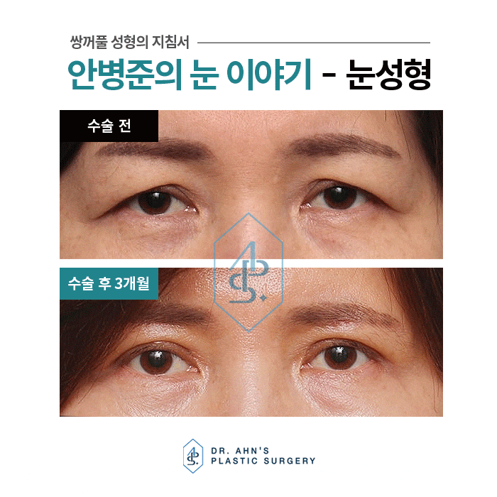 상안검성형술만으로 부족하시면 눈썹밑 절개와 같이? 관련 이미지 2