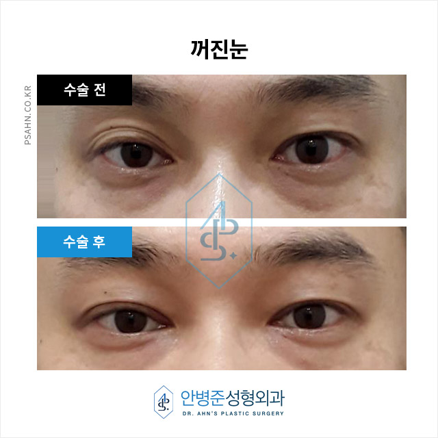 남성 쌍꺼풀 - 자연스러운 이미지 개선과 기능 회복 관련 이미지 6