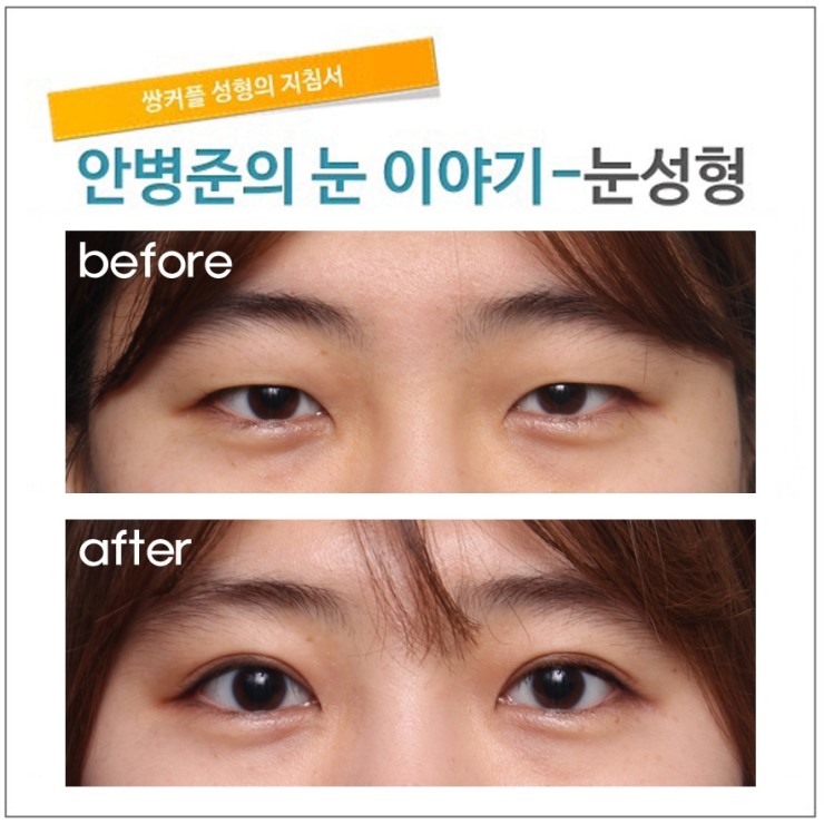 혹 안검하수는 아닌지? 관련 이미지 1