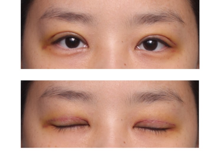 대표적인 단순 쌍꺼풀 수술.(쌍꺼풀수술,기본쌍꺼풀수술,자연스러운쌍꺼풀) 관련 이미지 3