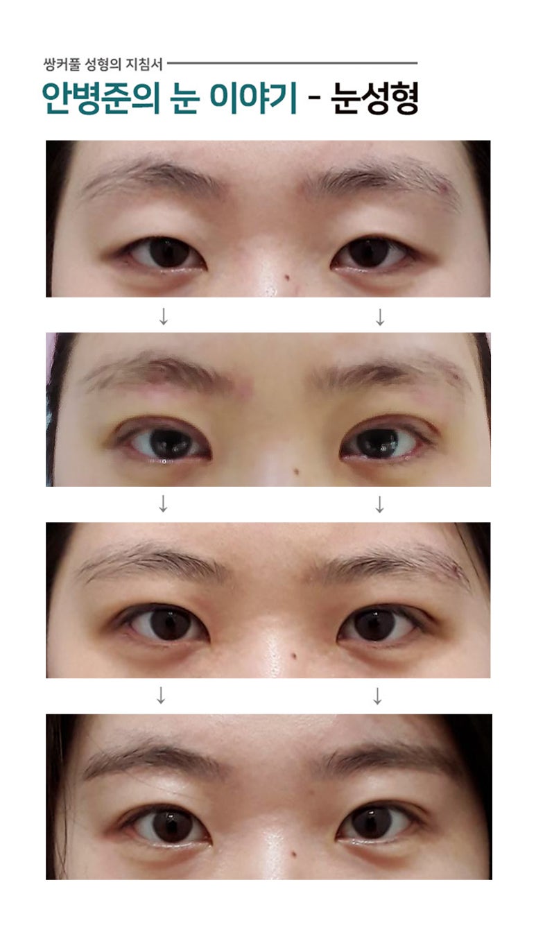 절개법(자연스러운 쌍수) 관련 이미지 1