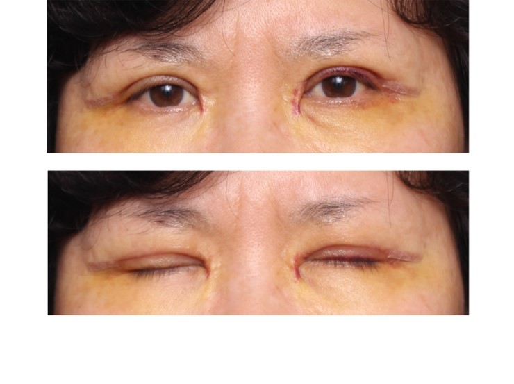 상안검성형술 관련 이미지 3