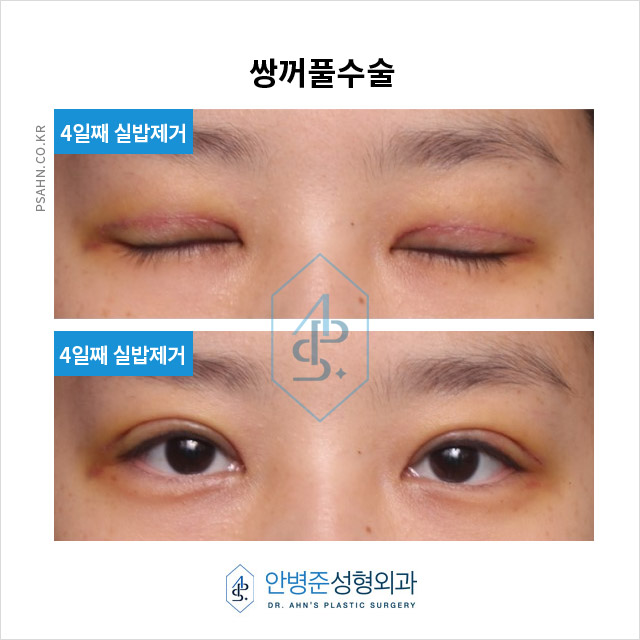 [강남성형외과] 쌍꺼풀수술 정보 - 절개법 수술사례 관련 이미지 2