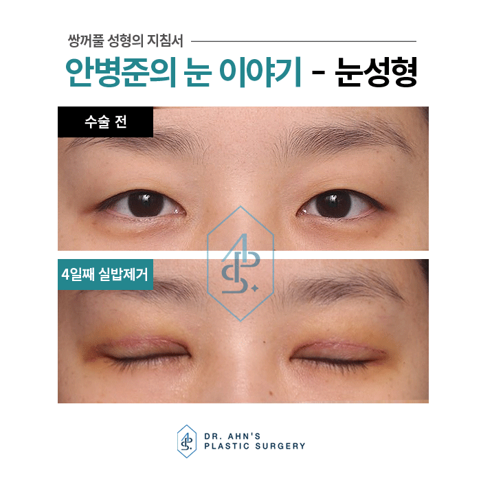 [자연스러운 쌍꺼풀] 4일째 실밥제거 / 3개월 후 사진 관련 이미지 6