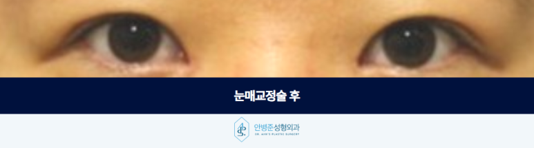 Ptosis Correction Surgery: If Your Eyebrows Are Raised, Improve Ptosis First image 3