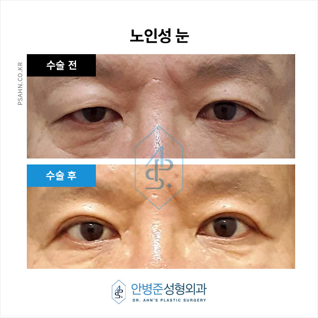 남성 쌍꺼풀 - 자연스러운 이미지 개선과 기능 회복 관련 이미지 7