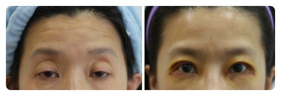 -눈매교정술에 대하여-             [안병준의 눈이야기] 관련 이미지 1