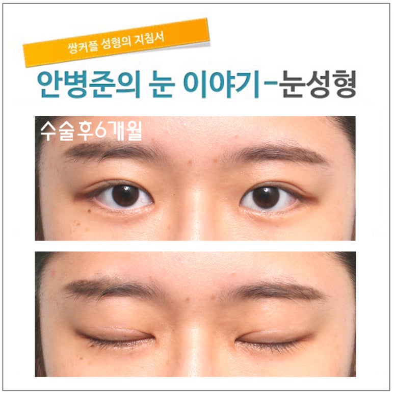 동양인 눈(자연 쌍꺼풀,자연스러운쌍꺼풀수술) 관련 이미지 4