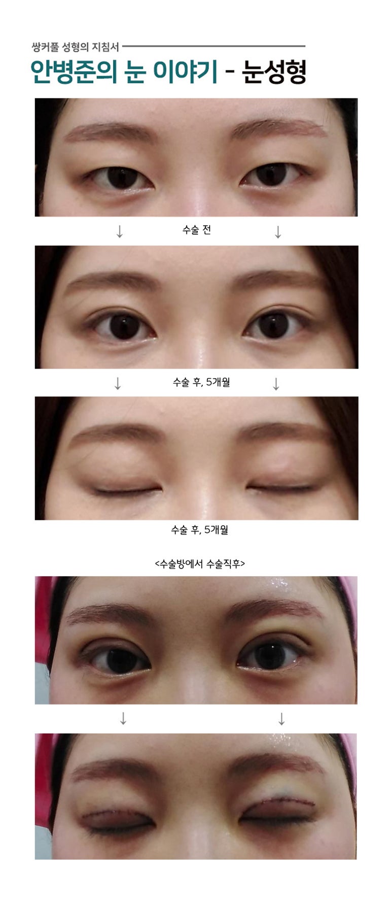 가장 이상적인 쌍꺼풀수술(쌍수,예쁜쌍수) 관련 이미지 1