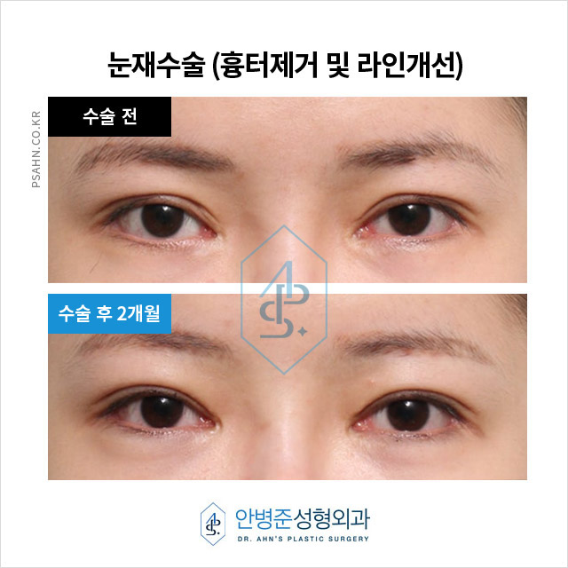 눈성형재수술,왜 필요한 걸까요? 흔한 실패 원인 분석 관련 이미지 1