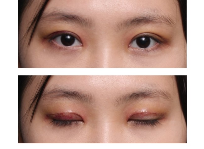 눈성형 수술엔 환자의 협조도 꼭 필요합니다. 관련 이미지 3