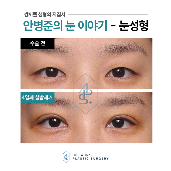 [자연스러운 쌍꺼풀] 4일째 실밥제거 / 3개월 후 사진 관련 이미지 5